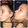 High frenquency acne facial