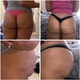 LipoSculpt 7 Day follow up