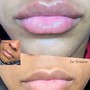 Hyaluron Lip Filler 1ml (1 session)