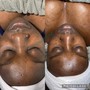 Teen Facial