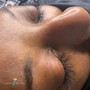 Microdermabrasion