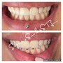 Tooth Gem Removals