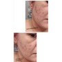 Scar Resurfacing Treatment