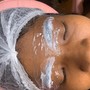 Acne Facial