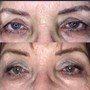 Plasma lift upper eye