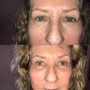 MicroNeedling