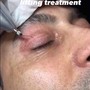 MicroNeedling