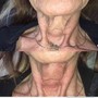 Plasma  neck lift