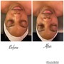 Oxygen Facial