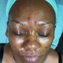 Glycolic Peel