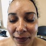 Acne Facial