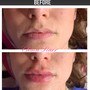 Lips Hyaluron Pen (Needle-less Lip Injections)