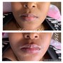 Lips Hyaluron Pen (Needle-less Lip Injections)