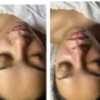 Microdermabrasion Facial