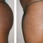 3/30 Min. Skin Tightening Cavitation - Thighs