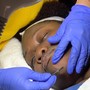 MicroNeedling Eyes