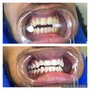 Teeth Whitening