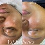 Dermaplaning Facial