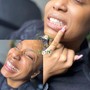 Mid Treatment Teeth Whitening