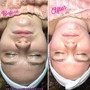 Facial