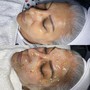 Acne Facial