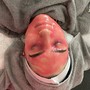 Half Back Chemical Peel