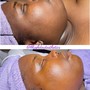 Dermaplaning