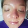 Retinoil Peel