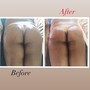 Butt Lift Therapy/ Vacuum Therapy