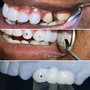 Couples Whitening