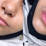 Hyaluron Lip Filler 1ml (1 session)