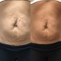 (10 Ultrasonic Cavitation & Wood Therapy)