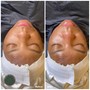 Back Facial Peel