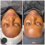 Back Facial Peel