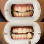 Top or bottom 6 teeth