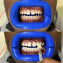 Top or bottom 6 teeth