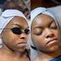 Flesh Glow facial (Dermaplaning)