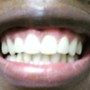 Pro Teeth Whitening 30 Minutes