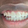 Pro Teeth Whitening 30 Minutes