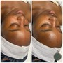 Back Facial Peel