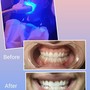 Teeth Whitening