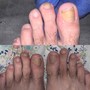 Callus Removal