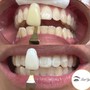 Teeth Whitening