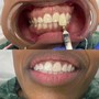 Teeth Whitening