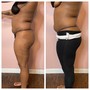 1 Laser Lipo or Fat Cavitation