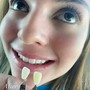 Teeth Whitening