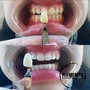 Teeth Whitening