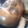 Acne Facial