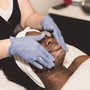 Microdermabrasion