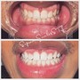 NEW Teeth Whitening Club!